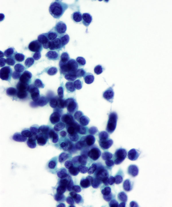 10 : Soft Tissue Ewing Sarcoma