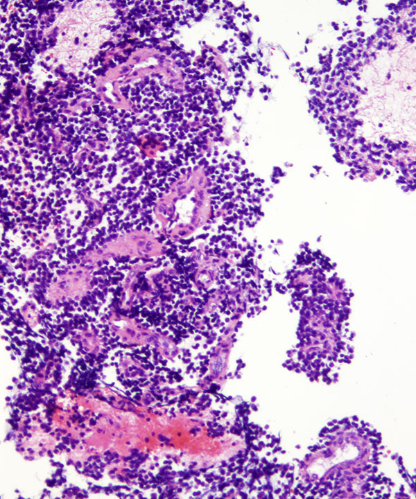 11 : Soft Tissue Ewing Sarcoma