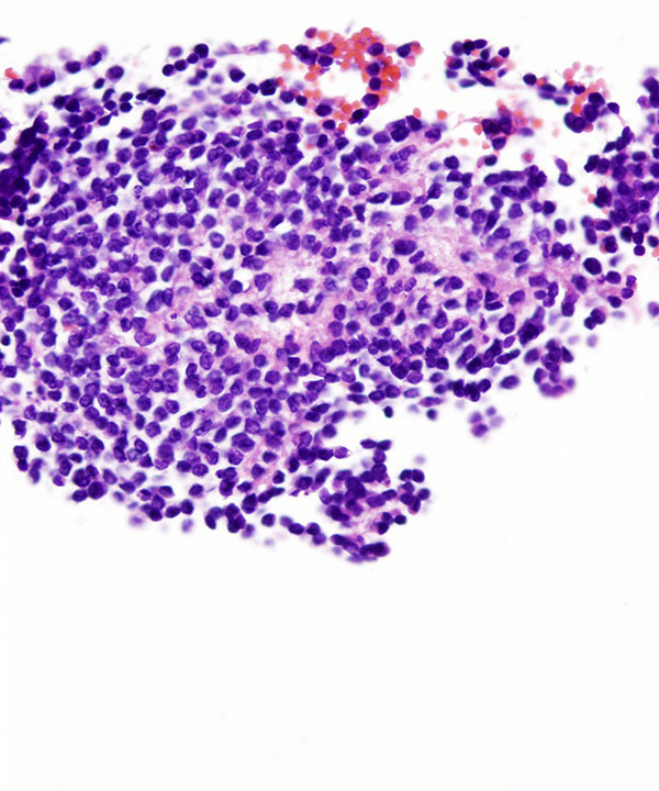 12 : Soft Tissue Ewing Sarcoma
