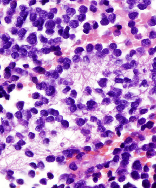 13 : Soft Tissue Ewing Sarcoma