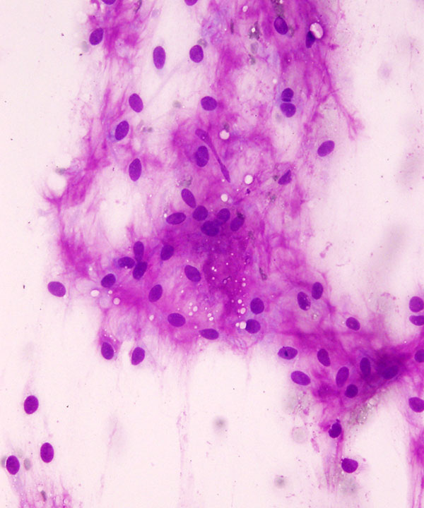 03 : Soft Tissue Extraskeletal Myxoid Chondrosarcoma