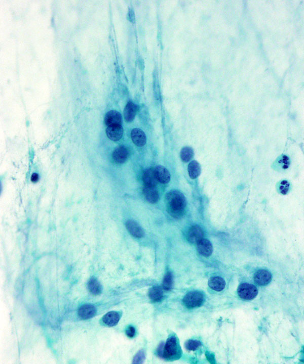 05 : Soft Tissue Extraskeletal Myxoid Chondrosarcoma