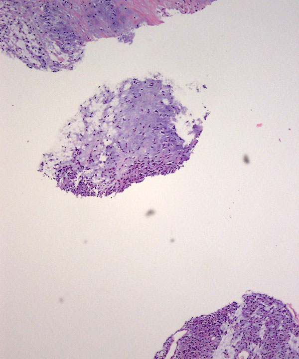 08 : Soft Tissue Extraskeletal Myxoid Chondrosarcoma