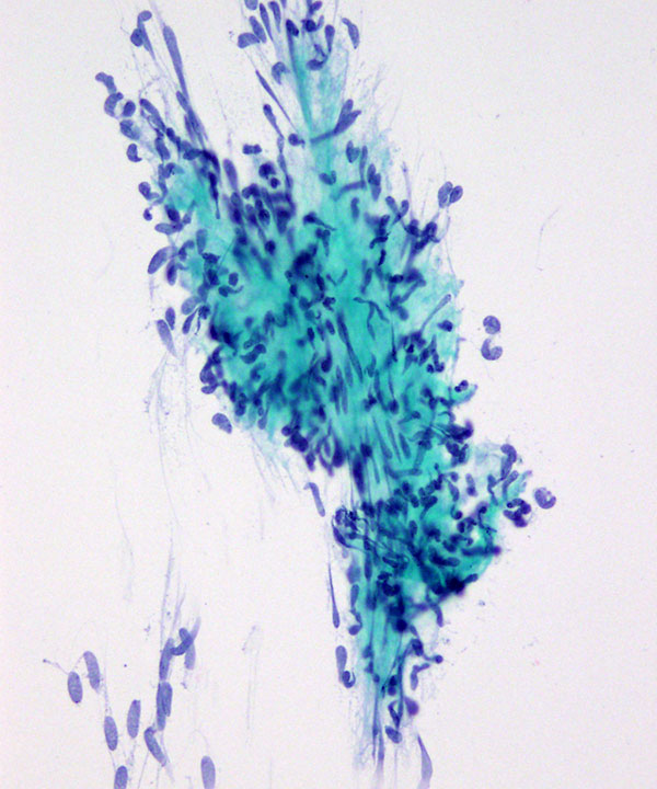 image showing 'Gastrointestinal stromal tumor (GIST)'