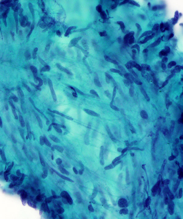 02 : Soft Tissue GIST
