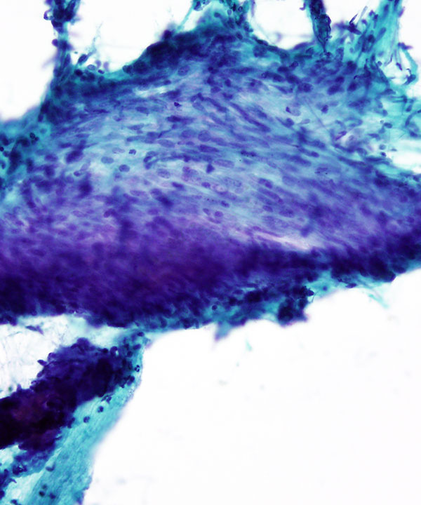 03 : Soft Tissue GIST