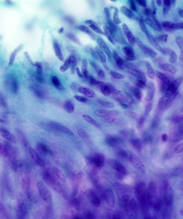 04 : Soft Tissue GIST