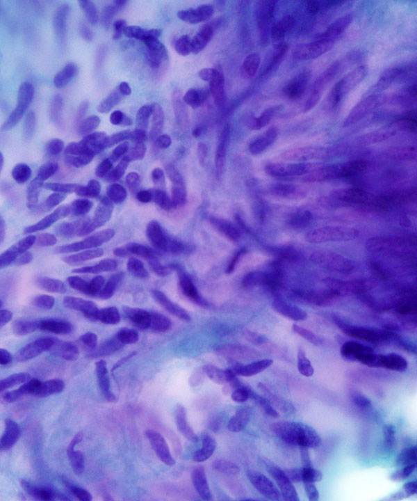05 : Soft Tissue GIST