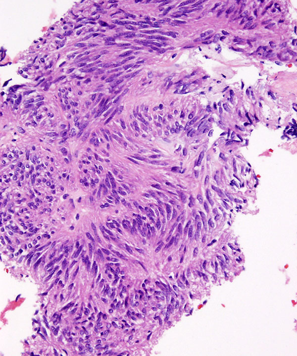 06 : Soft Tissue GIST