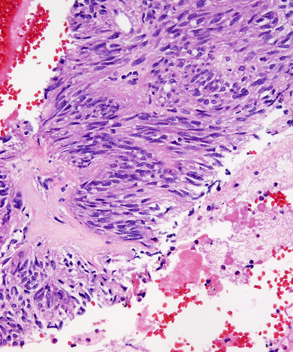 07 : Soft Tissue GIST