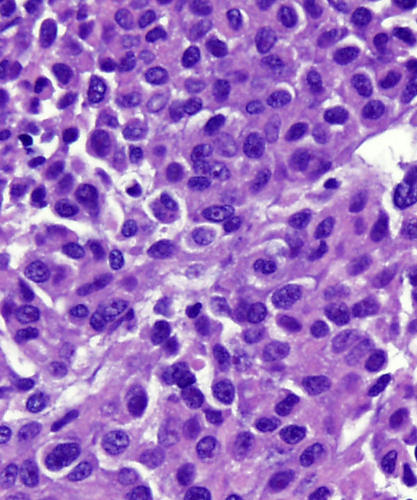 12 : Soft Tissue GIST