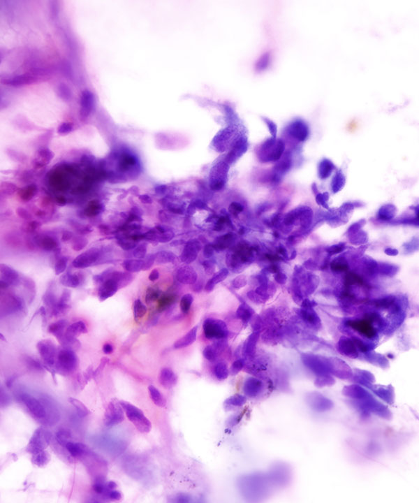 02 : Soft Tissue Leiomyosarcoma (LMS)