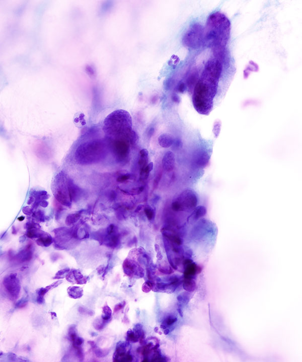 03 : Soft Tissue Leiomyosarcoma (LMS)
