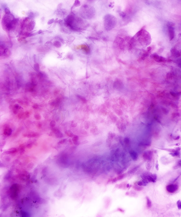 04 : Soft Tissue Leiomyosarcoma (LMS)