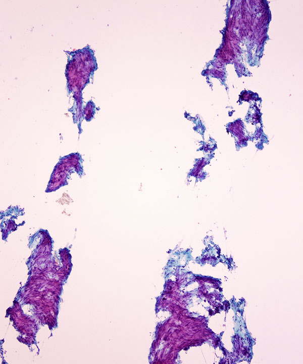 01 : Soft Tissue Leiomyoma