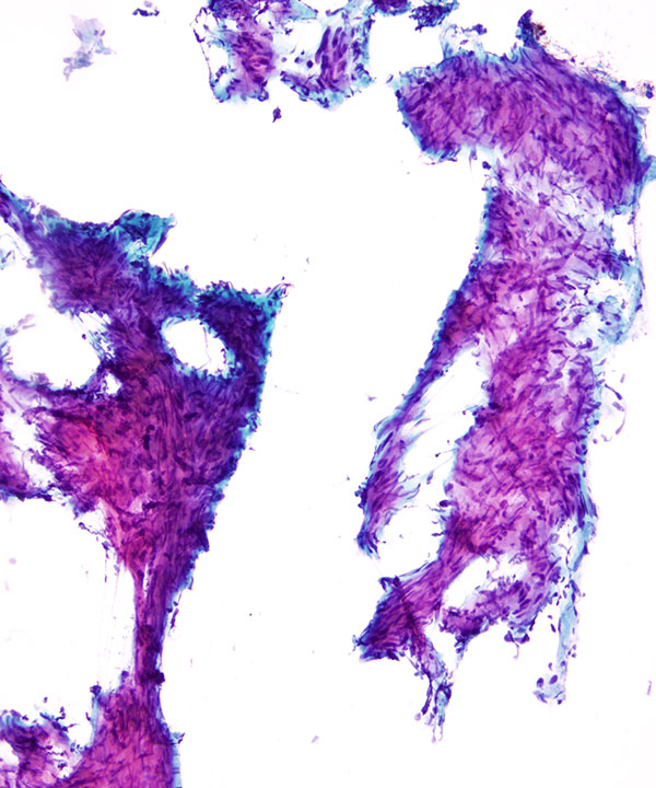 02 : Soft Tissue Leiomyoma