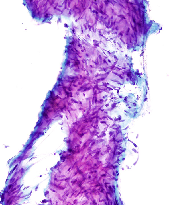 03 : Soft Tissue Leiomyoma