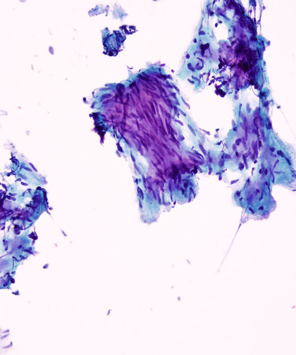 04 : Soft Tissue Leiomyoma