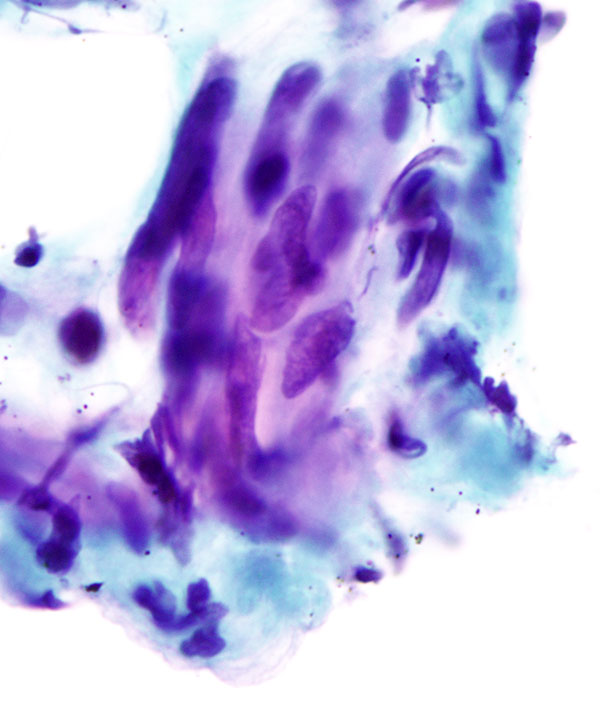 05 : Soft Tissue Leiomyoma