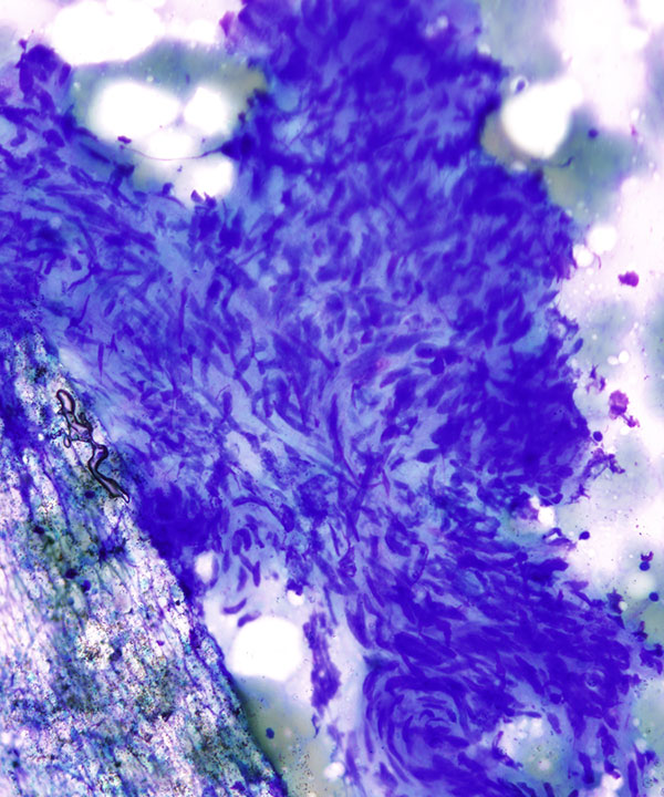 image showing 'Leiomyoma'