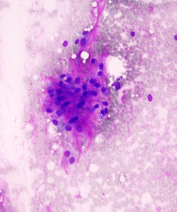 01 : Soft Tissue Myxoid Chondrosarcoma