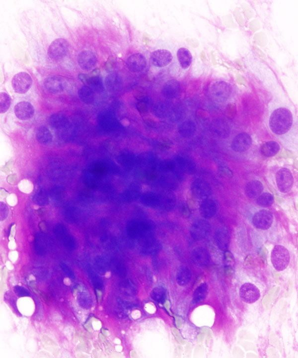 02 : Soft Tissue Myxoid Chondrosarcoma
