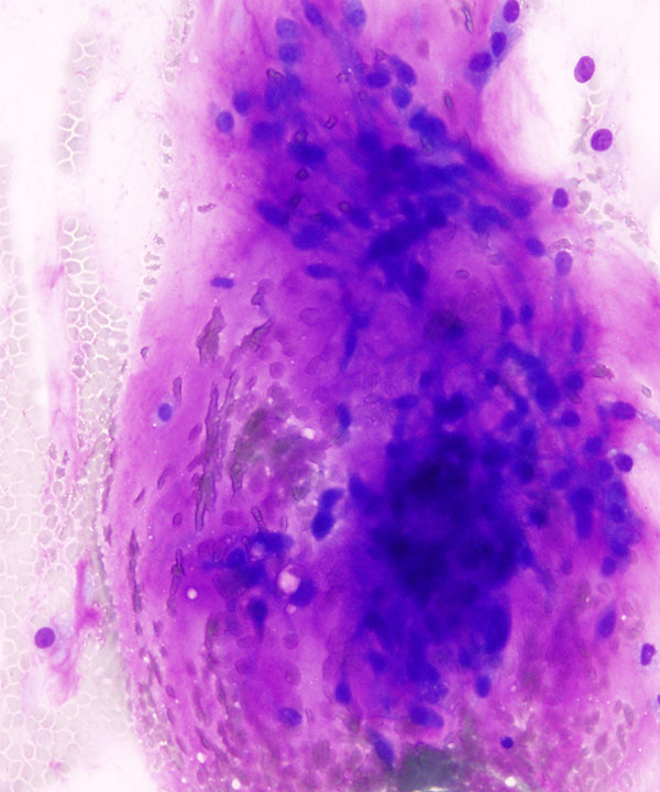03 : Soft Tissue Myxoid Chondrosarcoma