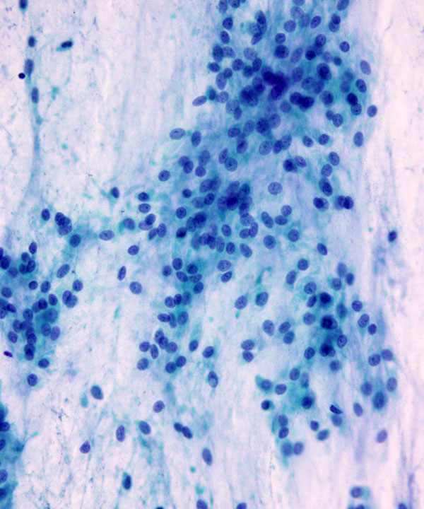 04 : Soft Tissue Myxoid Chondrosarcoma