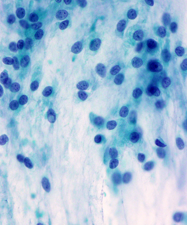 05 : Soft Tissue Myxoid Chondrosarcoma