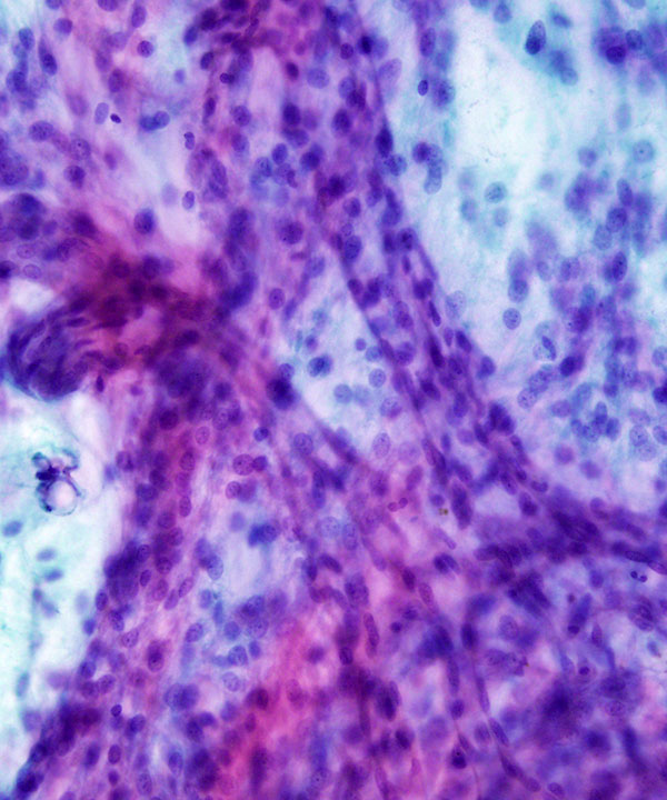 06 : Soft Tissue Myxoid Chondrosarcoma