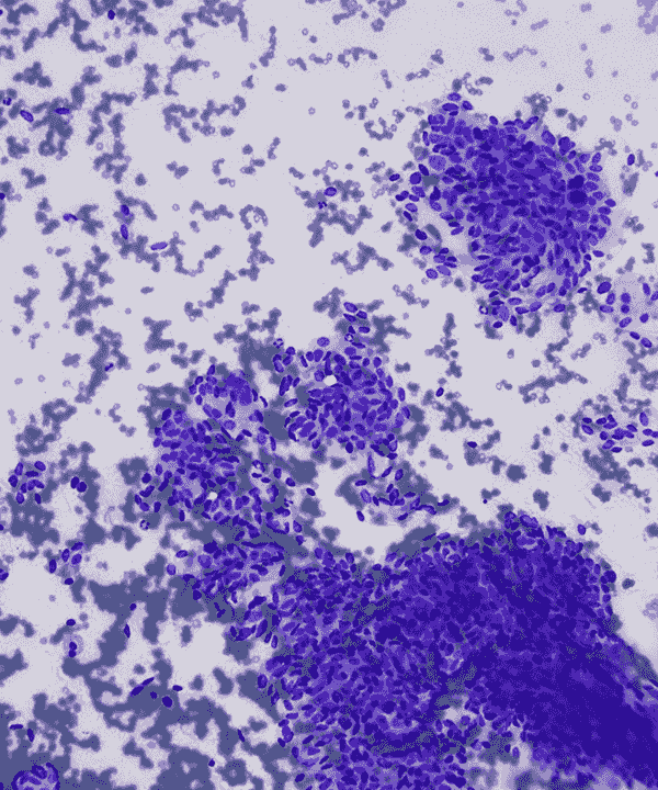 image showing 'Synovial Sarcoma'