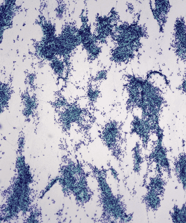 2 : Soft Tissue Synvoial Sarcoma - Monophasic