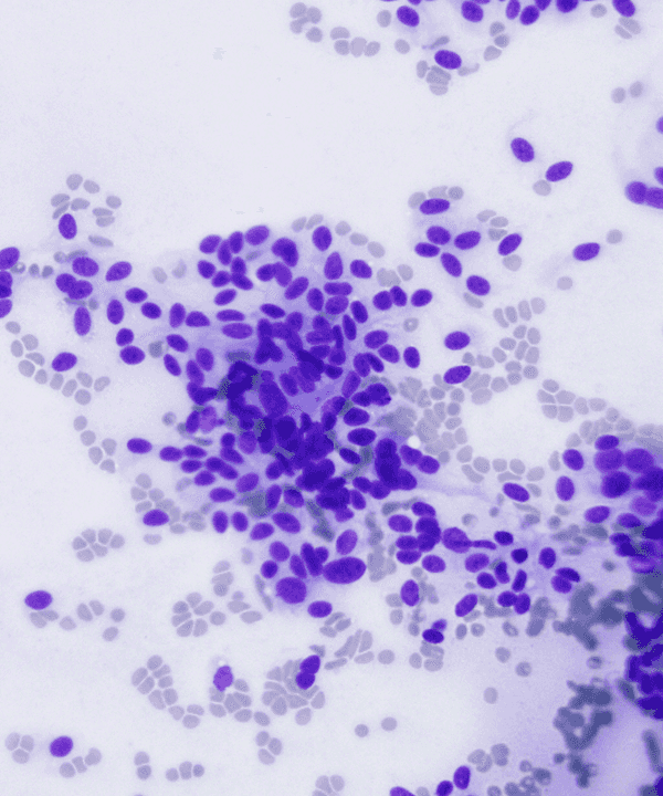 3 : Soft Tissue Synvoial Sarcoma - Monophasic