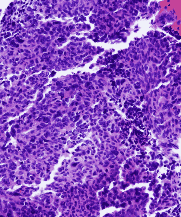 6 : Soft Tissue Synvoial Sarcoma - Test