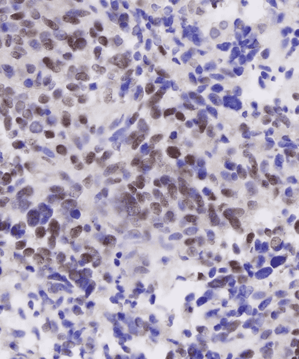 5 : Soft Tissue Synvoial Sarcoma - Monophasic