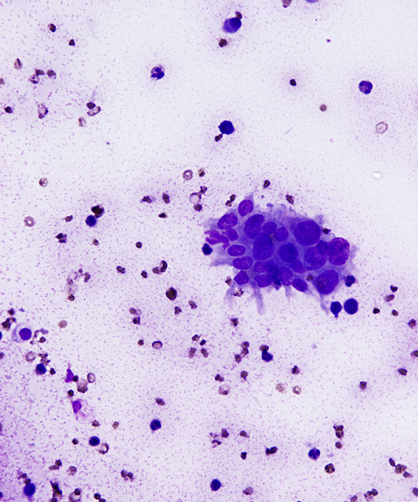 02 : Thyroid Anaplastic (Undifferentiated) Carcinoma