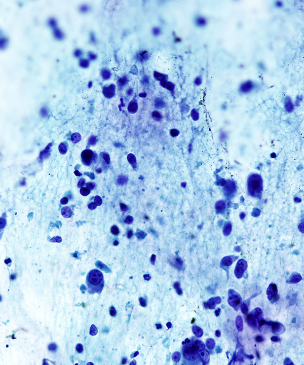 04 : Thyroid Anaplastic (Undifferentiated) Carcinoma