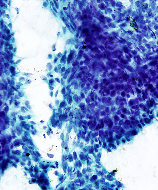 05 : Thyroid Anaplastic (Undifferentiated) Carcinoma