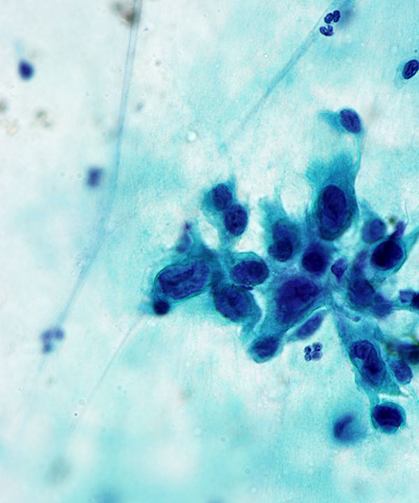 06 : Thyroid Anaplastic (Undifferentiated) Carcinoma