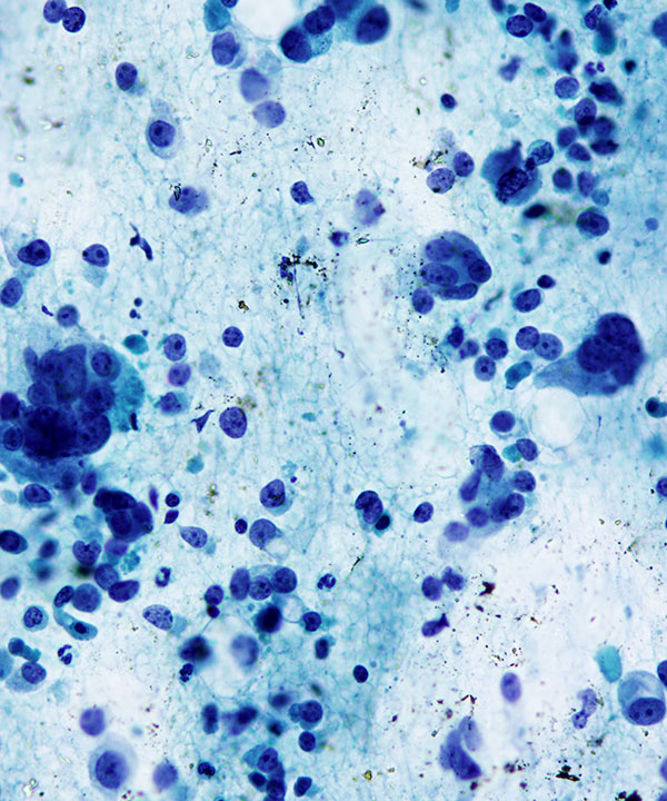 07 : Thyroid Anaplastic (Undifferentiated) Carcinoma