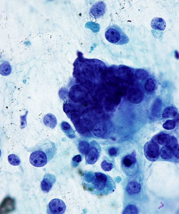 08 : Thyroid Anaplastic (Undifferentiated) Carcinoma
