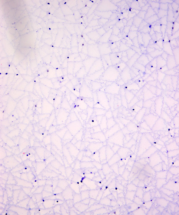 03 : Thyroid Colloid Nodule