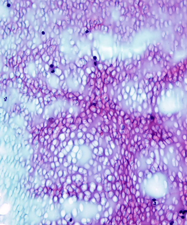 05 : Thyroid Colloid Nodule