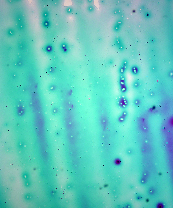 06 : Thyroid Colloid Nodule