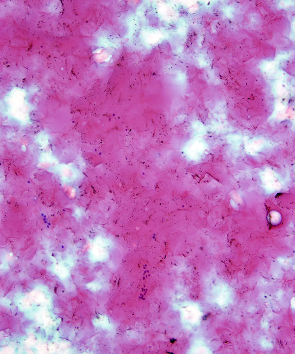 08 : Thyroid Colloid Nodule