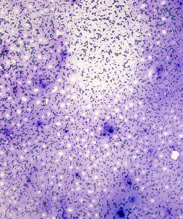 09 : Thyroid Colloid Nodule