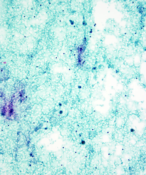11 : Thyroid Colloid Nodule