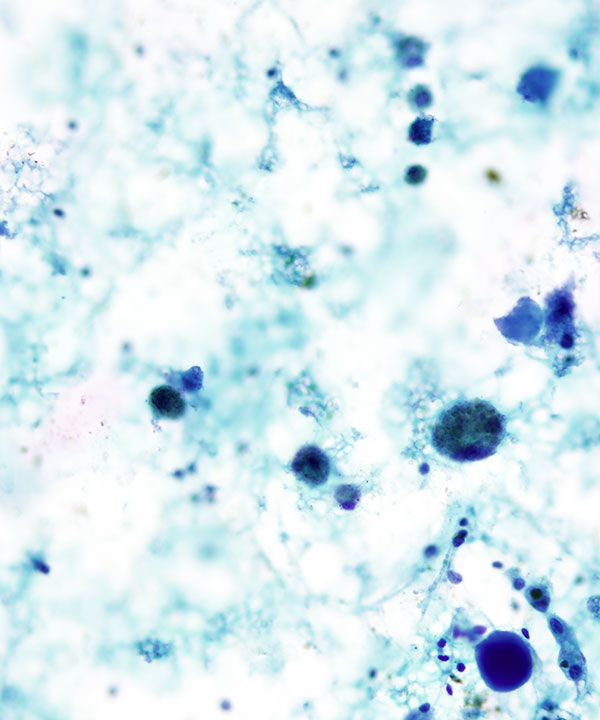 12 : Thyroid Colloid Nodule