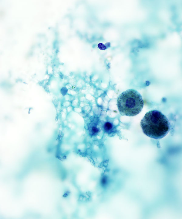 13 : Thyroid Colloid Nodule