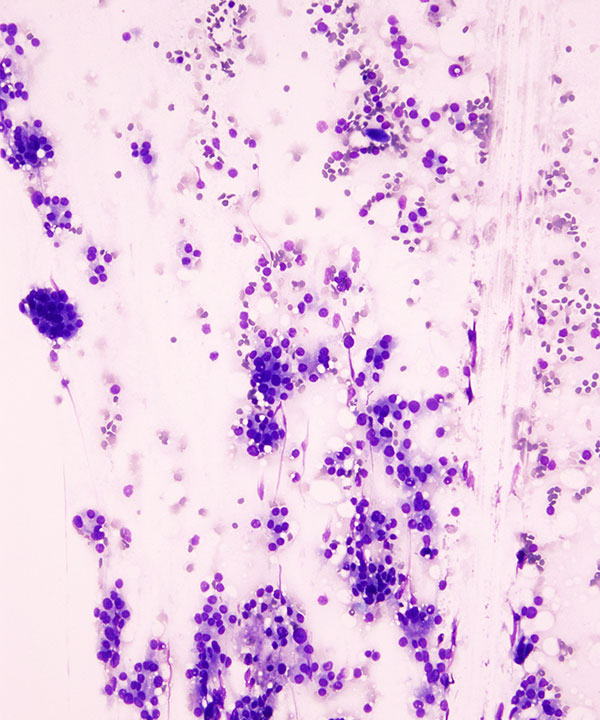 03 : Thyroid Follicular Neoplasm
